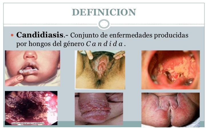 Es eficaz la medicina contra el hongo sobre la uña